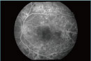 Photo : Fluorescein fundus angiography (FA)