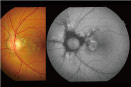 Photo : Fundus autofluorescence (FAF*)